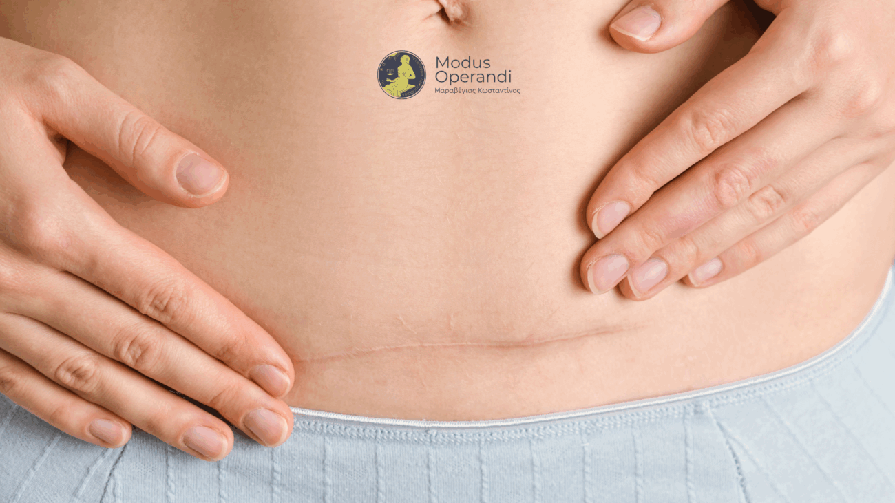 κήλη μετά από καισαρική cover